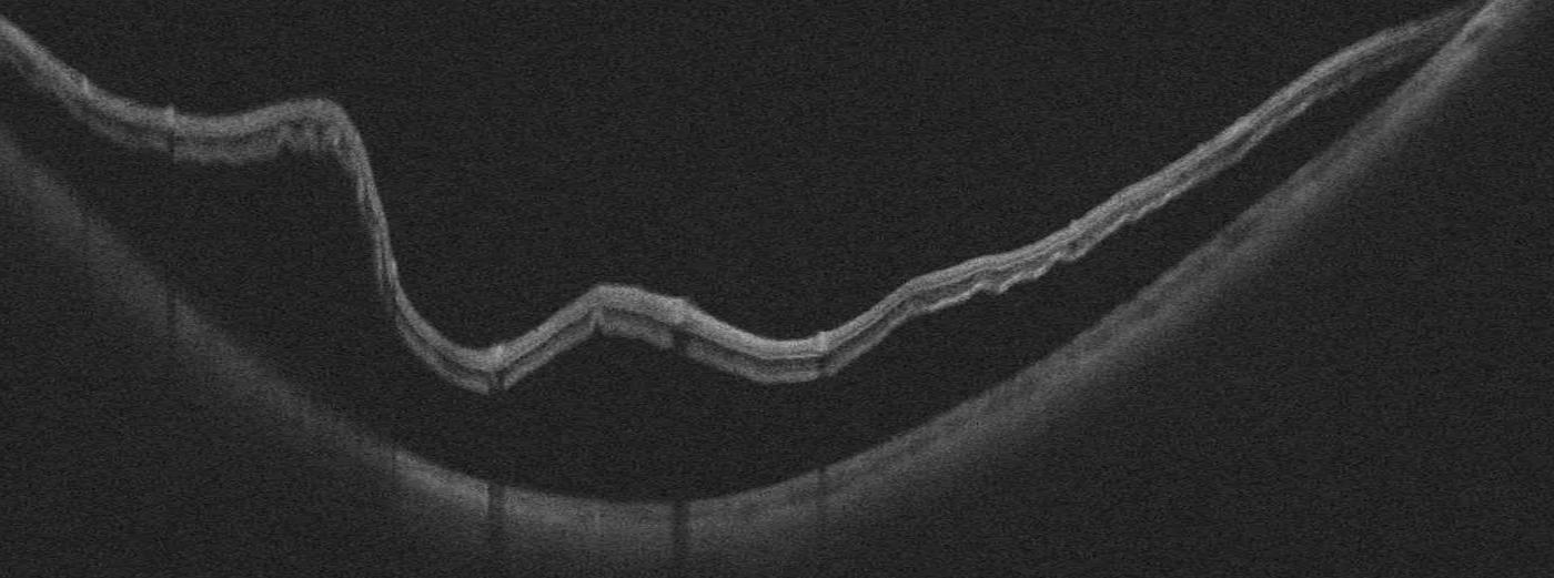 OCT Intalight montrant un décollement de rétine avec soulèvement neurorétinien